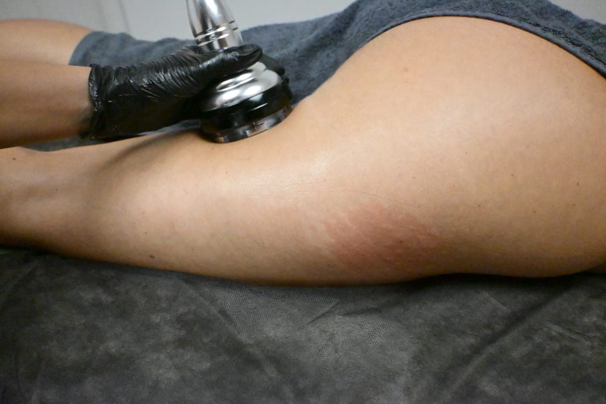 Ultrasonic Cavitation